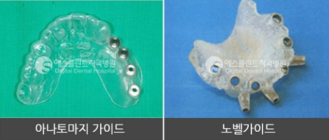 노벨가이드 vs 아나토마지가이드 임플란트 관련 이미지 9