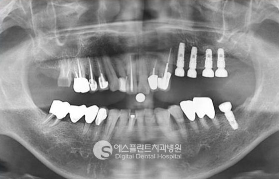어금니 임플란트, 튼튼하고 자연스럽게 [에스플란트 치과병원] 관련 이미지 2