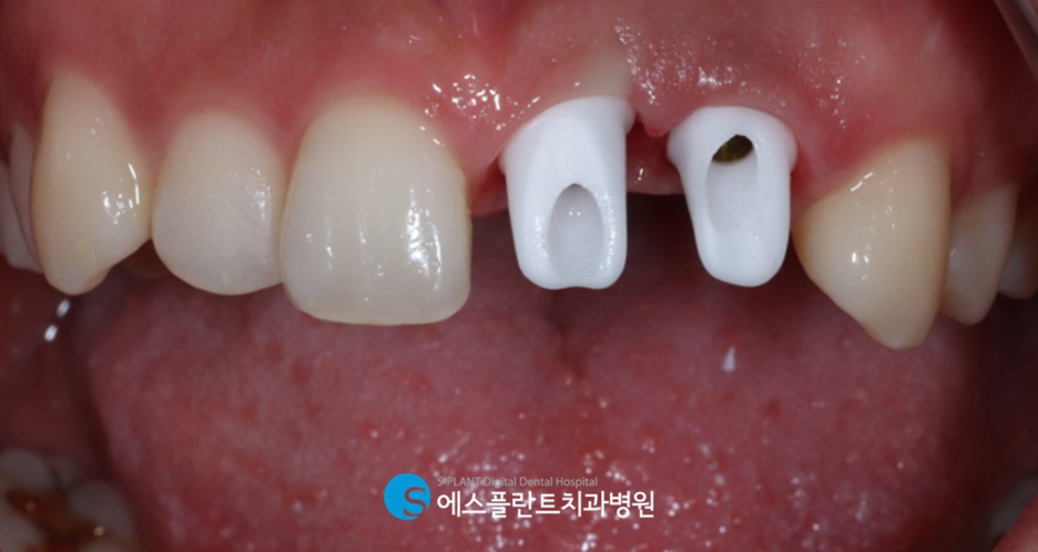 앞니 임플란트 잘하는 강남 치과, 에스플란트치과병원의 만족도 높은 앞니 심미 임플란트 관련 이미지 5