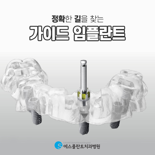 올바른길을 빠르게 찾아 식립하는 에스플란트의 가이드 임플란트 관련 이미지 3