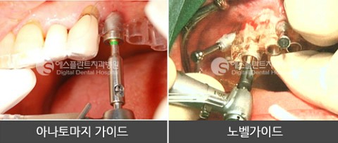 노벨가이드 vs 아나토마지가이드 임플란트 관련 이미지 10