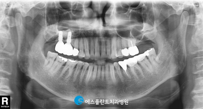 고난이도 임플란트 상악동거상술이 필요한 경우는? 관련 이미지 5
