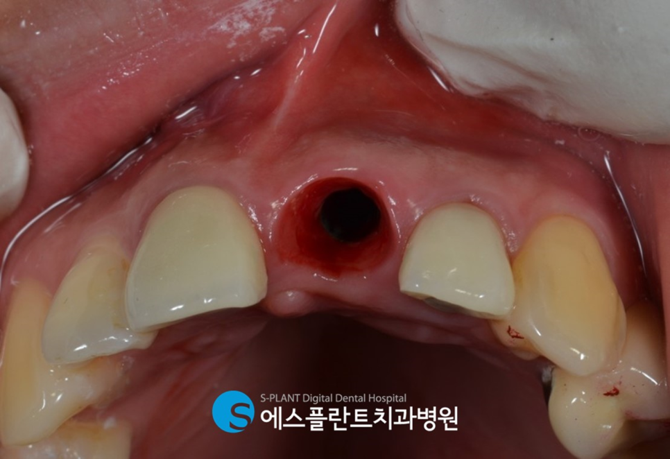 압구정로데오역 임플란트치과 에스플란트치과병원의 심미성을 고려한 지르코니아 지대주 앞니 임플란트 관련 이미지 2
