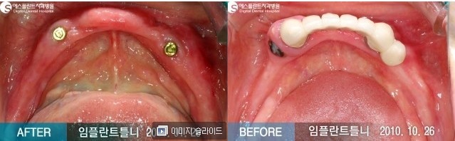 [임플란트후기] 뼈이식 임플란트, 임플란트 틀니 전/후 Story 임플란트 CASE 관련 이미지 6
