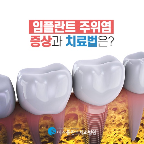 생각보다 많은 분들이 앓고 지나간 임플란트 주위염 [에스플란트 치과병원] 관련 이미지 2