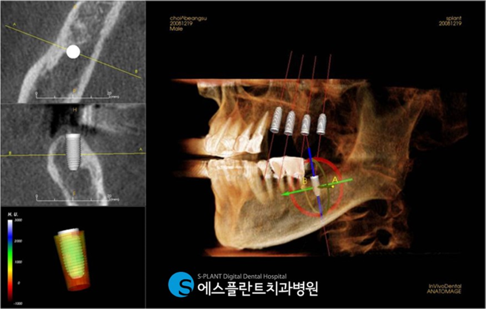 상악 무치악 환자 삶을 질을 높여주는 에스플란트치과병원의 상악 Full Case 임플란트 관련 이미지 3
