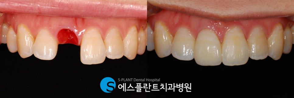 A case of regaining confidence with immediate implant placement after front tooth extraction at Esplant Dental Hospital, a dental clinic near Apgujeong Rodeo Station known for implants image 7