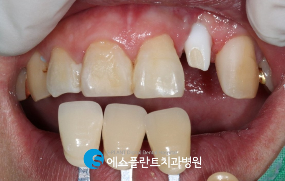 아름다운 미소를 위한 앞니 임플란트는 압구정로데오 에스플란트 치과병원에서 관련 이미지 8