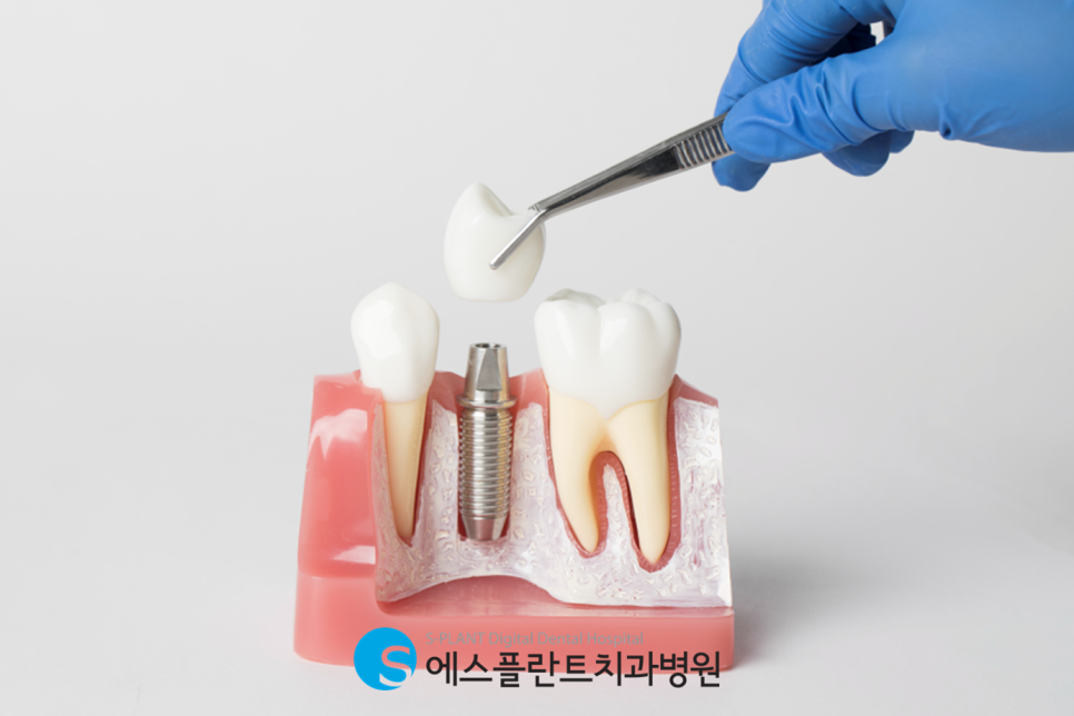 압구정로데오치과 하루임플란트, 빠르고 안전하게 관련 이미지 2