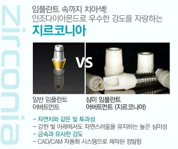 [앞니임플란트] 앞니 임플란트가격, 어금니 임플란트 가격 관련 이미지 4
