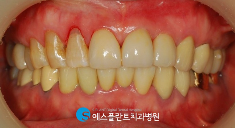 치아노화로 인한 기능 및 심미적인 부분의 개선을 원한다면?! 강남 앞니 심미보철 잘하는 치과 에스플란트치과병원에서 관련 이미지 5