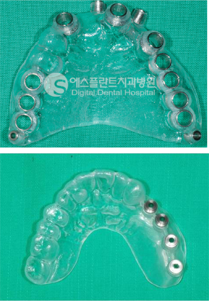 [청담동임플란트]전체임플란트,당일즉시기능임플란트시술과정 관련 이미지 3