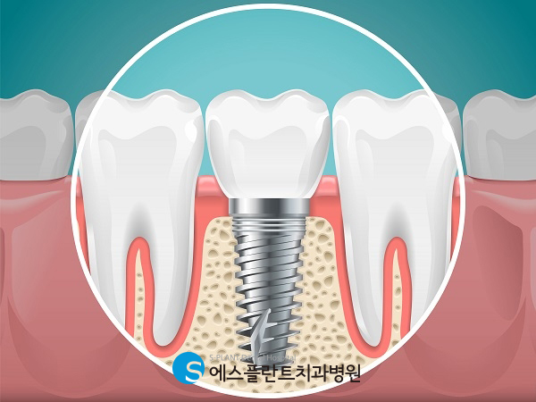 학동사거리 임플란트 잘하는 치과, 에스플란트치과에서 알려주는 임플란트 과정: 수술 전후 주의사항 관련 이미지 2