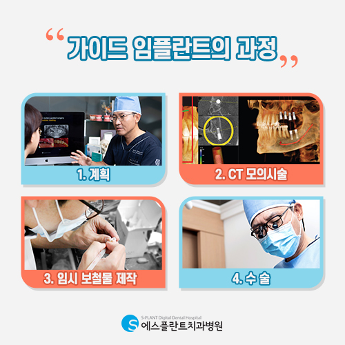 학동사거리 임플란트 잘하는 치과, 에스플란트치과병원의 디지털 가이드 임플란트로 정확하게 식립 관련 이미지 4