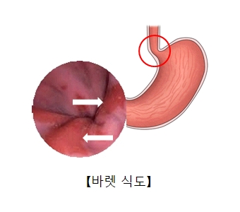 역류성 식도염, 치아와 구강 건강까지 해칩니다. [에스플란트 치과병원] 관련 이미지 2
