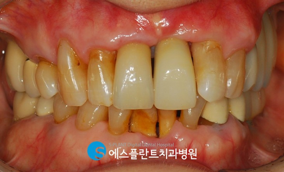 앞구정앞니임플란트 심한 치주염으로 인한 골이식을 동반한 전치부 앞니 임플란트 관련 이미지 7