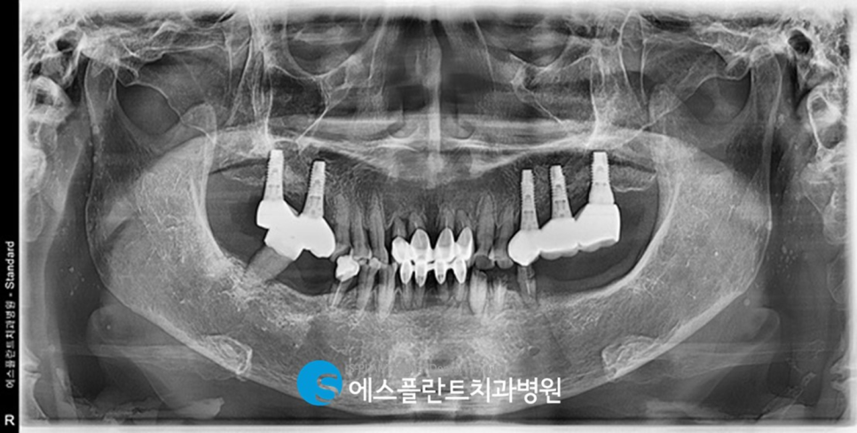 흔들리는 앞니 가이드 임플란트 브릿지 잘하는 치과 에스플란트치과병원 관련 이미지 2