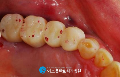 저작기능의 핵심, 어금니 임플란트 식립에는 압구정 에스플란트 치과병원의 가이드 임플란트 관련 이미지 10