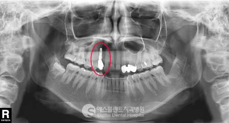 잇몸에 임플란트 기둥이 비쳐서 고민이었던 환자분의 사례 관련 이미지 2