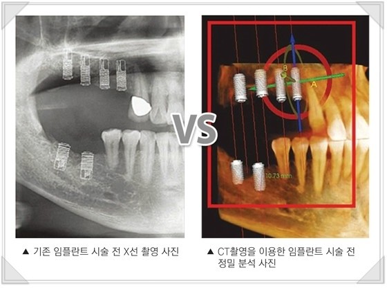 [CT임플란트] 3D CT 임플란트, 아나토마지 가이드 임플란트 관련 이미지 1