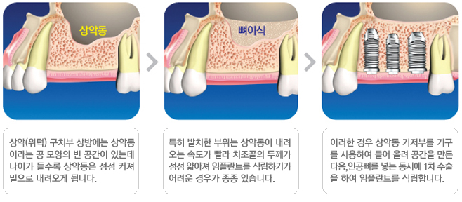 뼈이식임플란트]뼈이식임플란트 후 주의사항, 상악동거상술과정 관련 이미지 3