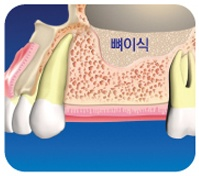 [뼈이식 임플란트] 임플란트잘하는치과, 잇몸 뼈 이식 꼭 해야만 하나요? 관련 이미지 1