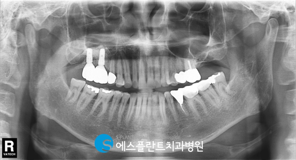 고난이도 상악동 거상술 임플란트 잘하는 치과, 에스플란트 치과병원 관련 이미지 8