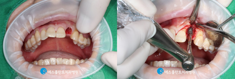 당일 임플란트 원데이 임플란트 수술이 가능한 강남치과, 에스플란트치과병원 관련 이미지 5