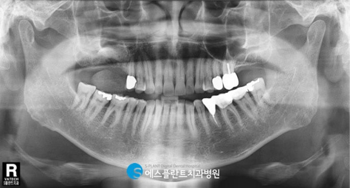고난이도 임플란트 상악동거상술이 필요한 경우는? 관련 이미지 2