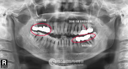 치아의 심미성은 사회성과도 연결됩니다 [에스플란트 치과병원] 관련 이미지 1