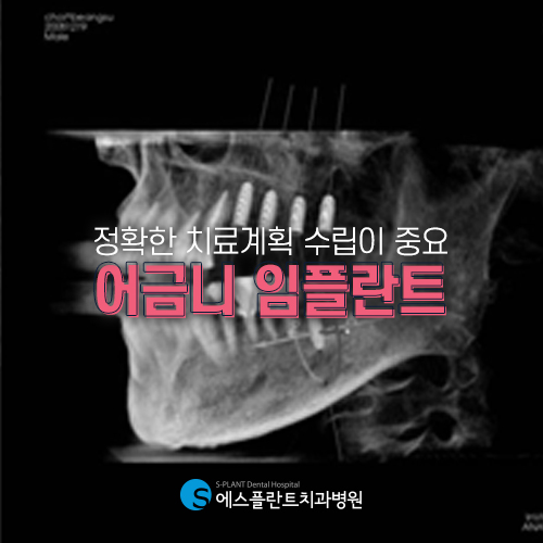 높은 강도와 정확도가 중요한 어금니 임플란트 [에스플란트 치과병원] 관련 이미지 4