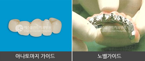 노벨가이드 vs 아나토마지가이드 임플란트 관련 이미지 11