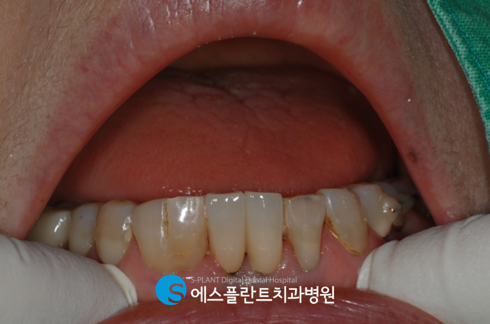 하악 앞니 임플란트 식립 잘하는 치과, 에스플란트 치과병원에서 정확하게! 관련 이미지 7