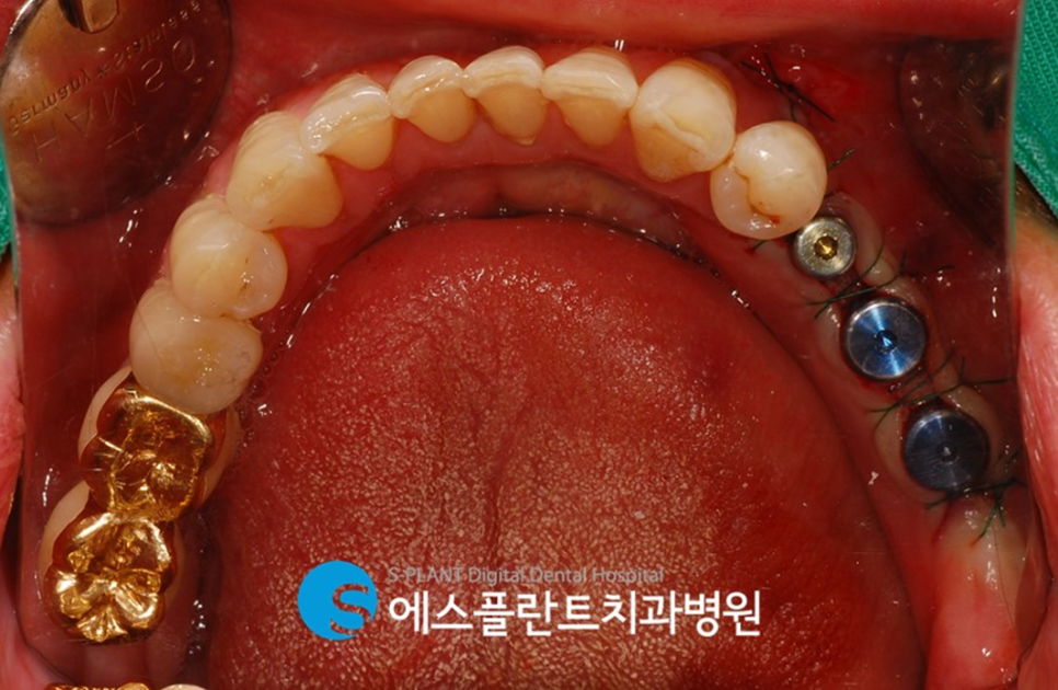 골이식을 동반한 고난이도 임플란트 시술 잘하는 치과, 에스플란트치과병원 관련 이미지 8
