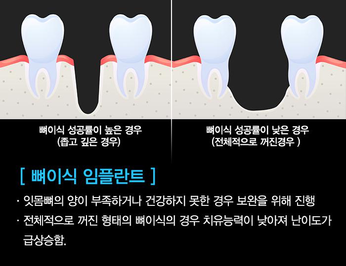 임플란트뼈이식을해야하는데,뼈이식통증이걱정되시나요? 관련 이미지 2