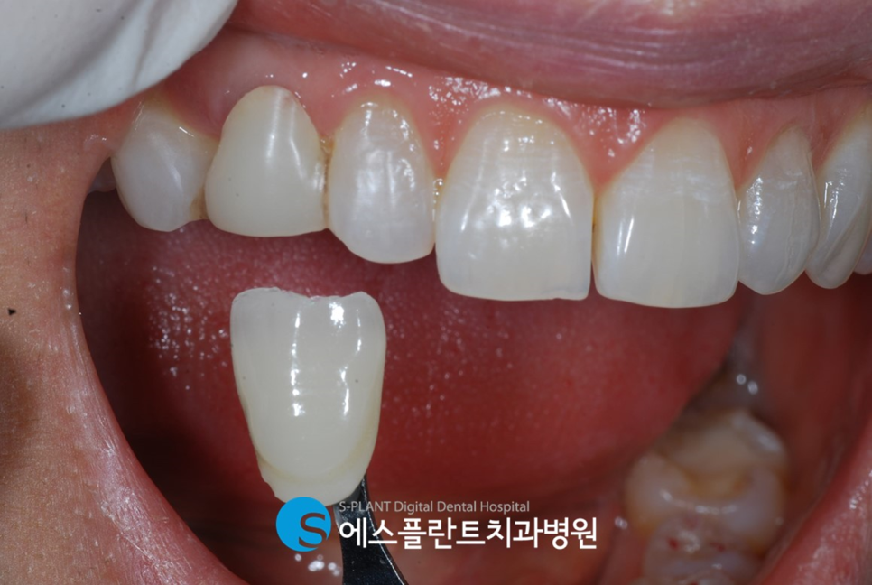 강남 임플란트 잘하는 곳, 에스플란트치과병원 송곳니 견치 임플란트 어떻게 하나요?! 관련 이미지 6