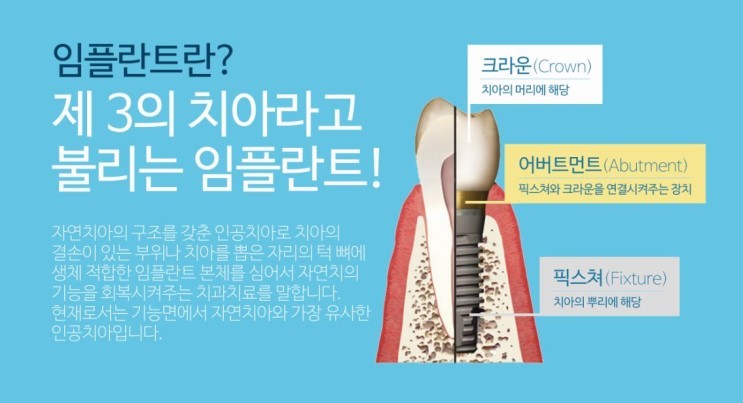 임플란트, 가격차이의 이유를 꼭 알아보세요. 관련 이미지 1