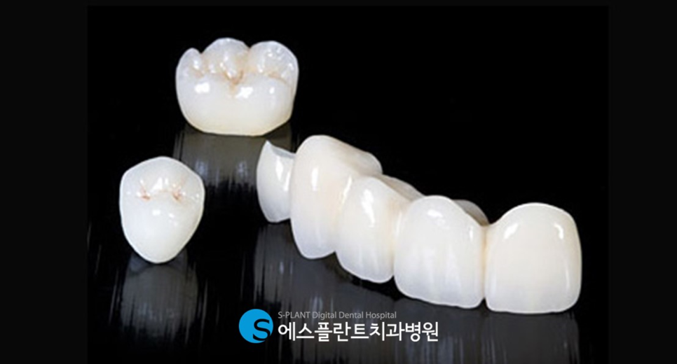 압구정치과 전치부 심미보철 수복 잘하는 에스플란트치과병원 관련 이미지 1