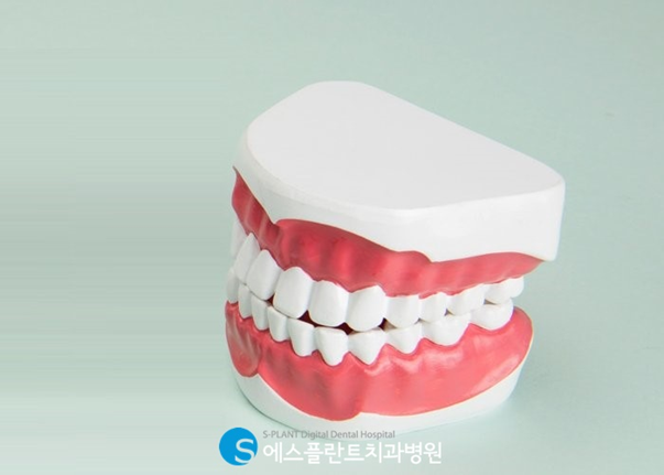 손상되고 상실된 치아를 대체하는 임플란트, 에스플란트치과에서 진행하세요! 관련 이미지 3
