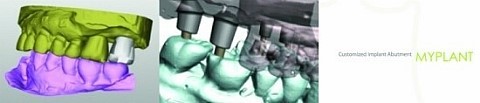 [임플란트잘하는병원] 국산임플란트가격, 임플란트종류 꼼꼼히 알아보 기 관련 이미지 6