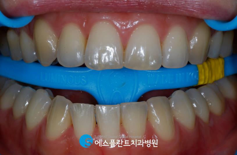 강남 전문가 치아미백, 에스플란트 치과병원에서 변색된 치아를 하얗게 관련 이미지 3
