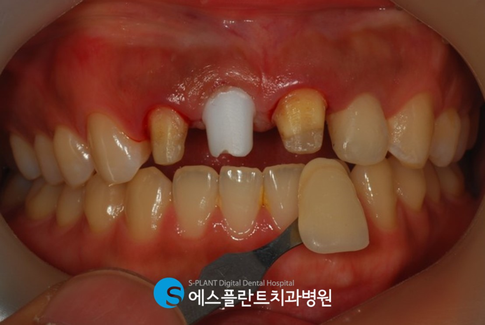 치아외상으로 인한 깨지고 부러진 치아, 강남 에스플란트치과병원에서 자연스럽게! 관련 이미지 5