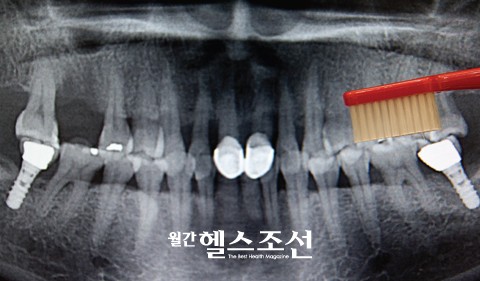 [임플란트주위염] 임플란트 심은 후 입내 심해졌다면?! 관련 이미지 1