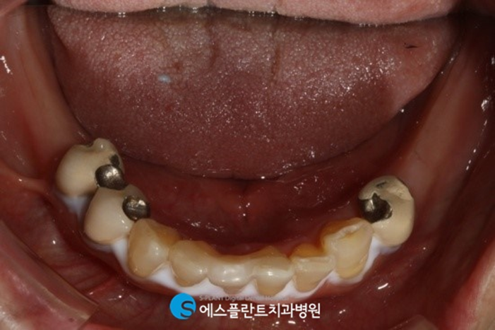 먹는 즐거움을 위한 어금니 임플란트를 소개합니다! 관련 이미지 3