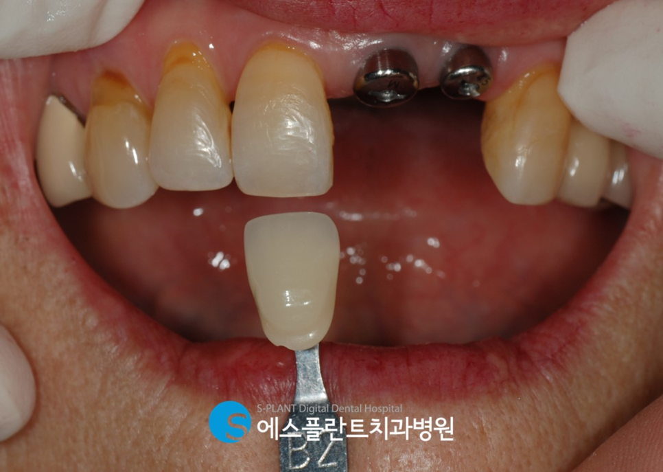 압구정 임플란트 잘하는 치과, 앞니 치관치근 파절 인한 임플란트 수술이 가능한 에스플란트치과병원 관련 이미지 5