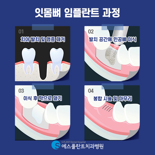 뼈이식 임플란트, 에스플란트의 충분한 상담을 통해 안전하게 진행 관련 이미지 5