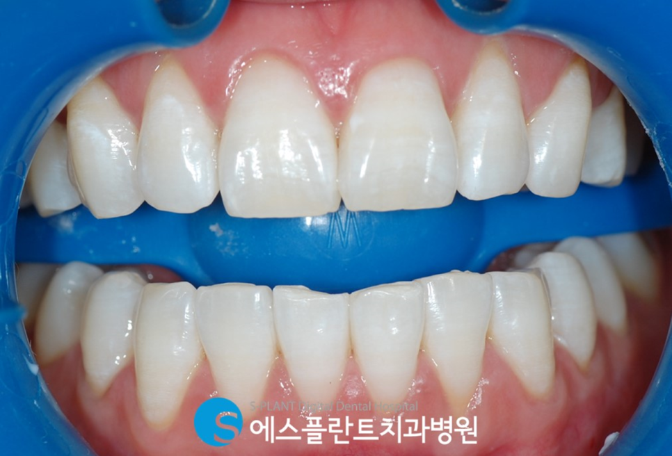 압구정로데오 치아미백 잘하는 치과, 에스플란트치과병원에서 착색된 치아를 하얗게 관련 이미지 4