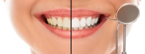 에스플란트치과병원 치아미백(전문가 미백) 무엇이 다를까요?? 관련 이미지 1