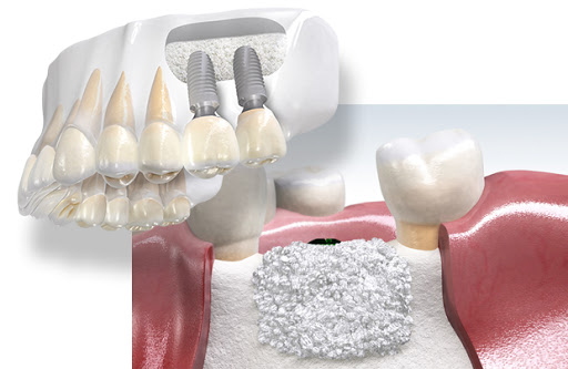 압구정 임플란트 잘하는 에스플란트 치과병원의 임플란트 FAQ 2탄 관련 이미지 5