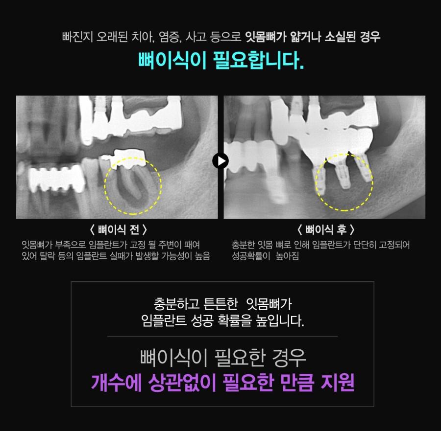 더튼튼한임플란트치료를원한다면에스플란트치과병원에문의하세 요. 관련 이미지 3